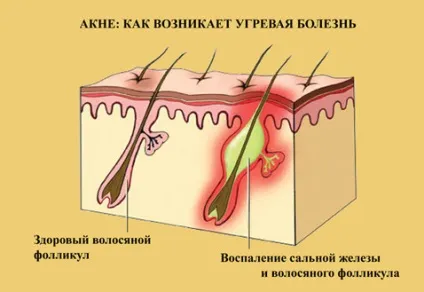 Акне вульгаріс (вугри звичайні) (вульгаріс) Акне вульгаріс (вугри звичайні)
