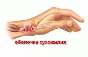 Якщо болить рука в зап'ясті, а ви не знаєте, що робити, здоров'я суглобів (травми рук) Якщо болить рука в зап'ясті, а ви не знаєте, що робити, здоров'я суглобів