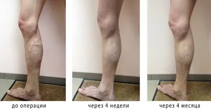 Ендовазальной лазерна коагуляція (ЕВЛК) - відгуки та рекомендації лікарів