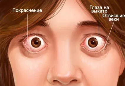 Ендокринна офтальмопатія симптоми, причини і лікування - будьте здорові