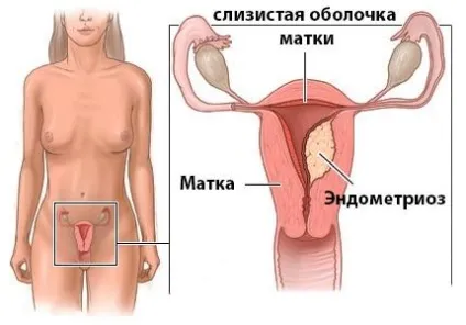 Ендометріоз матки симптоми, причини, діагностика, лікування, профілактика (матки) Ендометріоз матки симптоми, причини, діагностика, лікування, профілактика