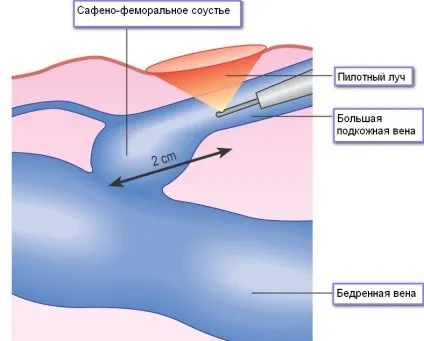 Ендовазальной лазерна коагуляція (ЕВЛК) - відгуки та рекомендації лікарів