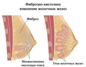 Фіброзно жирова інволюція молочних залоз що таке мастопатія, які зміни і трансформації (інволюція) Фіброзно жирова інволюція молочних залоз що таке мастопатія, які зміни і трансформації