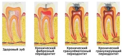 Фіброзний періодонтит симптоми і лікування захворювання (симптоми) Фіброзний періодонтит симптоми і лікування захворювання