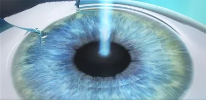 Femto lasik (фемто ЛАСІК) особливості методу лазерної корекції (ЛАСІК) Femto lasik (фемто ЛАСІК) особливості методу лазерної корекції