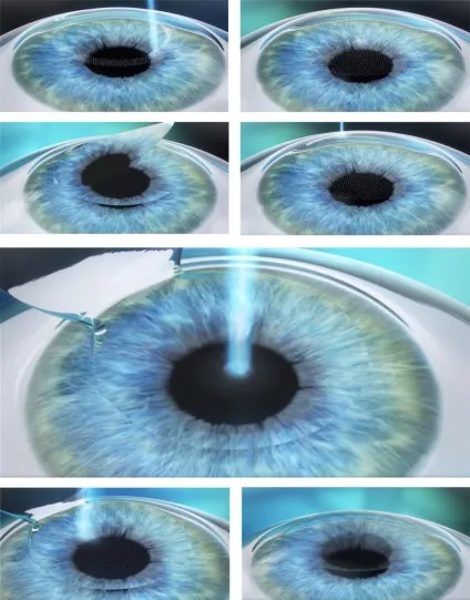 Femto lasik (фемто ЛАСІК) особливості методу лазерної корекції (femto) Femto lasik (фемто ЛАСІК) особливості методу лазерної корекції