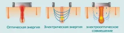 Фотоепілятор або лазерний епілятор що краще (лазерний) Фотоепілятор або лазерний епілятор що краще