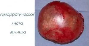 Геморагічна кіста яєчника особливості і причини розвитку, методи лікування та діагностики (яєчника) Геморагічна кіста яєчника особливості і причини розвитку, методи лікування та діагностики