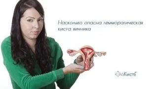 Геморагічна кіста яєчника - лікування, симптоми, прогноз (симптоми) Геморагічна кіста яєчника - лікування, симптоми, прогноз