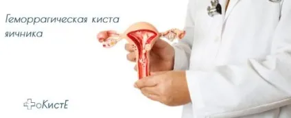 Геморагічна кіста яєчника - лікування, симптоми, прогноз (кіста) Геморагічна кіста яєчника - лікування, симптоми, прогноз