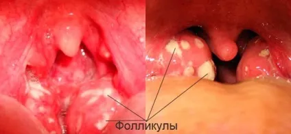 Гангліоніт - невралгія крилонебного вузла причини, симптоми, лікування, прогноз (симптоми гангліоніту) Гангліоніт - невралгія крилонебного вузла причини, симптоми, лікування, прогноз
