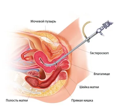 Гематометра лікування після медаборта, пологів, кесаревого розтину, вискоблювання і ін (лікування) Гематометра лікування після медаборта, пологів, кесаревого розтину, вискоблювання і ін