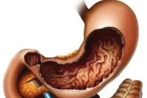 Гіпертрофічний гастрит лікування, дієта, симптоми (симптоми) Гіпертрофічний гастрит лікування, дієта, симптоми