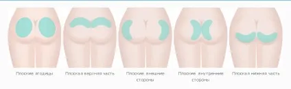 Глютеопластіка (пластика сідниць) - що це таке, фото до і після, відгуки, ціна (Глютеопластіка) Глютеопластіка (пластика сідниць) - що це таке, фото до і після, відгуки, ціна