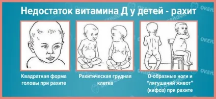 Гипокальциемия симптоми, причини гипокальциемии у дітей і дорослих, лікування гіпокальціємії (симптоми) Гипокальциемия симптоми, причини гипокальциемии у дітей і дорослих, лікування гіпокальціємії