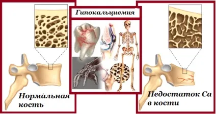 Гипокальциемия симптоми, причини гипокальциемии у дітей і дорослих, лікування гіпокальціємії (гипокальциемии) Гипокальциемия симптоми, причини гипокальциемии у дітей і дорослих, лікування гіпокальціємії