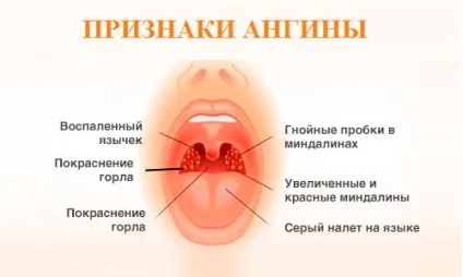 Гнійна ангіна як виглядає, симптоми і лікування (ангіна) Гнійна ангіна як виглядає, симптоми і лікування