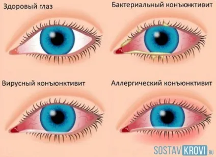 Гіперемія шкіри, обличчя, очей, зіва, у дітей і дорослих, лікування та профілактика