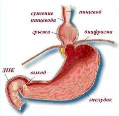 грижа стравоходу