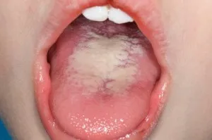 Грибок на мові лікування, причини та симптоми, derm-info (грибок) Грибок на мові лікування, причини та симптоми, derm-info