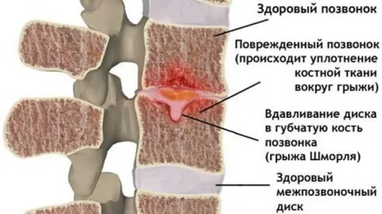 Грижа Шморля - як лікувати вузли і визначити симптоми і причини (вузли) Грижа Шморля - як лікувати вузли і визначити симптоми і причини