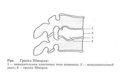 Грижа Шморля - що це таке, множинні, дрібні, центральні, інтракорпорального (таке) Грижа Шморля - що це таке, множинні, дрібні, центральні, інтракорпорального
