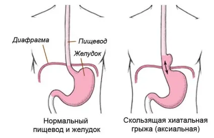 Грижа стравоходу - симптоми, лікування і дієта (нижній відділ стравоходу) Грижа стравоходу - симптоми, лікування і дієта