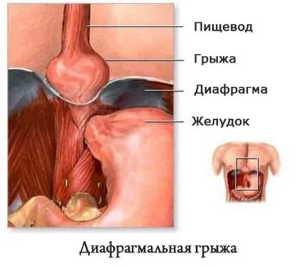 Грижа стравоходу - симптоми, лікування і дієта (симптоми) Грижа стравоходу - симптоми, лікування і дієта