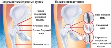 Інфекційний ревматоїдний артрит - що це і як з ним боротися (інфекційний ревматоїдний артрит) Інфекційний ревматоїдний артрит - що це і як з ним боротися