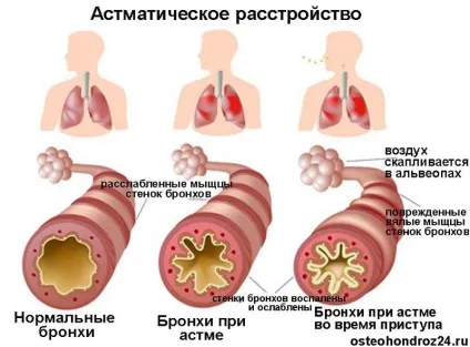 Інгалятори при бронхіальній астмі (бронхіальної) Інгалятори при бронхіальній астмі