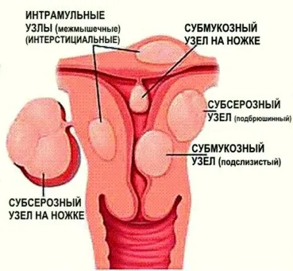 Інтерстиціальний вузол по передній стінці матки (вузол) Інтерстиціальний вузол по передній стінці матки