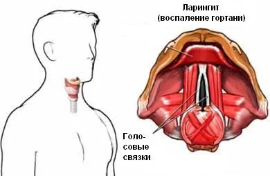 Алергічний набряк гортані - лікування, перша допомога (гортані) Алергічний набряк гортані - лікування, перша допомога