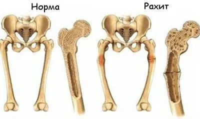 Аквадетрим »передозування у дітей і немовлят (аквадетрім) Аквадетрим »передозування у дітей і немовлят