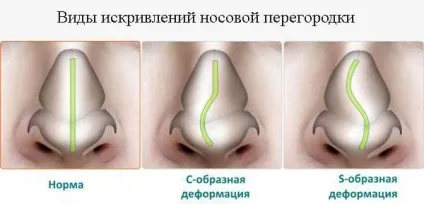 Викривлення носової перегородки лікування без операції, наслідки, лазером, у дитини, МКБ (лікування) Викривлення носової перегородки лікування без операції, наслідки, лазером, у дитини, МКБ