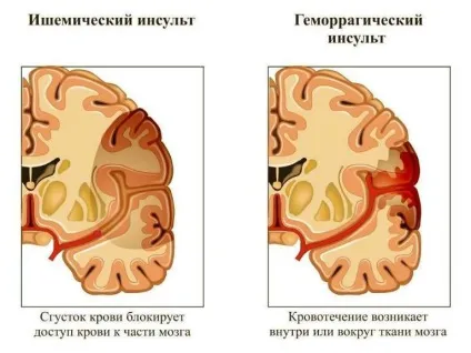 Ішемічний інсульт головного мозку лікування ліки і вдома (лікування) Ішемічний інсульт головного мозку лікування ліки і вдома