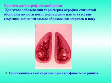 Викривлення носової перегородки лікування без операції, наслідки, лазером, у дитини, МКБ (лікування) Викривлення носової перегородки лікування без операції, наслідки, лазером, у дитини, МКБ