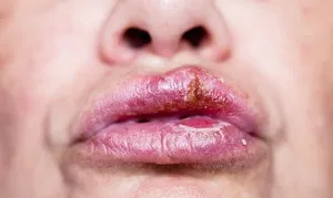 Як швидко позбутися від болячки на губі після застуди - woman s day (після) Як швидко позбутися від болячки на губі після застуди - woman s day