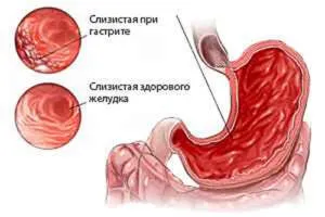 Яка кислотність при атрофічному гастриті і як її визначити (кислотність) Яка кислотність при атрофічному гастриті і як її визначити