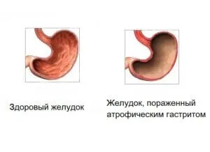 Яка кислотність при атрофічному гастриті і як її визначити (яка) Яка кислотність при атрофічному гастриті і як її визначити