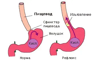 Печія причини виникнення, симптоми і лікування (симптоми) Печія причини виникнення, симптоми і лікування