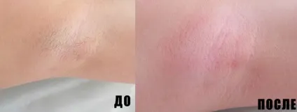 Як діє крем для депіляції плюси і мінуси (діє) Як діє крем для депіляції плюси і мінуси