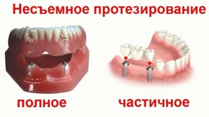 Які зубні протези краще ціни, відгуки, фото (фото) Які зубні протези краще ціни, відгуки, фото