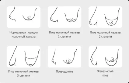 Як виправити птоз молочних залоз (птоз) Як виправити птоз молочних залоз