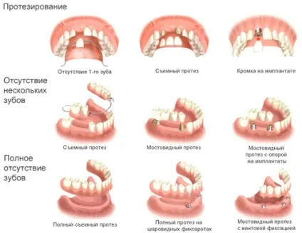 Які зубні протези краще ціни, відгуки, фото (відгуки) Які зубні протези краще ціни, відгуки, фото