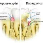 Як лікувати пародонтит в домашніх услових лікування і профілактика