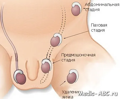 Як лікувати крипторхізм