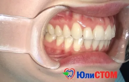 Як правильно зберігати зуби (правильно) Як правильно зберігати зуби