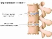 Анкілозуючий спондилоартрит симптоми і лікування