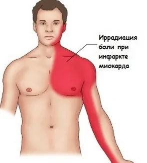 Ангинозная форма інфаркту міокарда, типова форма (ангінозний) Ангинозная форма інфаркту міокарда, типова форма