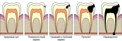 Ампутація пульпи, етапи вітального і девітальной видалення пульпи (етапи) Ампутація пульпи, етапи вітального і девітальной видалення пульпи